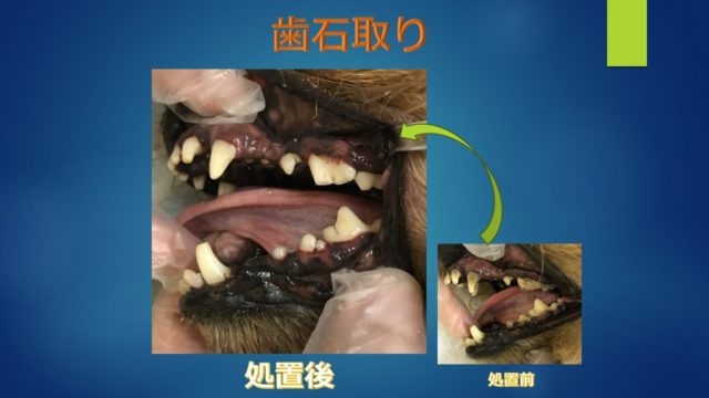 歯石とり